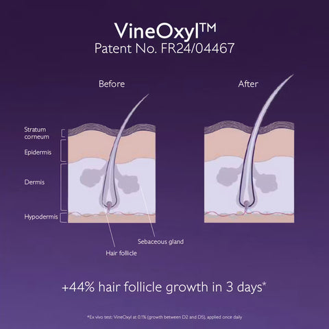 An informational graphic on hair follicle growth comparison, showing labeled cross-sections of a hair follicle labeled 'Before' and 'After' on a purple background with the text 'VineOxyl' and 'Patent No. FR24/04467'.