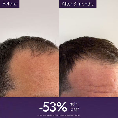 Before and after comparison of a man's scalp showing hair growth after 3 months, with text reading 'Before', 'After 3 months', and '-53% hair loss*'.
