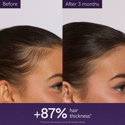 Before-and-after comparison of a woman's hairline showing increased hair density and thickness after 3 months, with text reading '+87% hair thickness' on a purple banner.