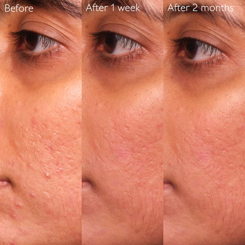 Caudalie | Vinopure Blemish Control Salicylic Acid Serum
